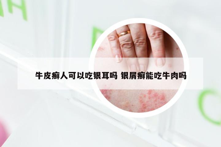 牛皮癣人可以吃银耳吗 银屑癣能吃牛肉吗