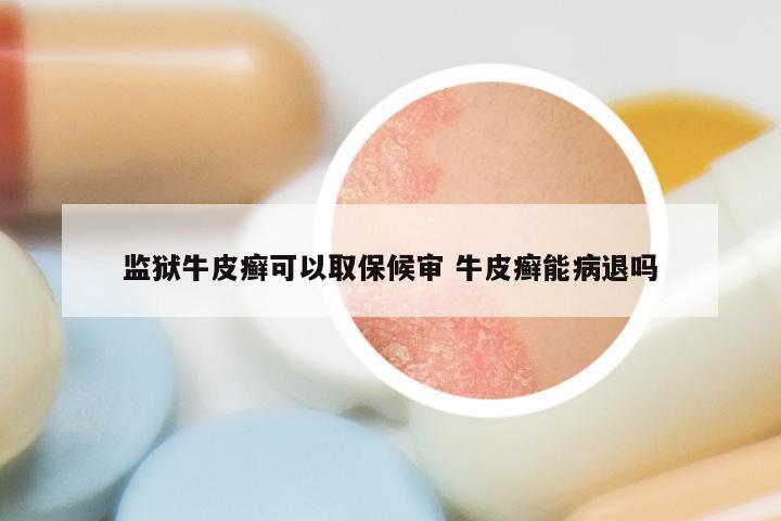 监狱牛皮癣可以取保候审 牛皮癣能病退吗
