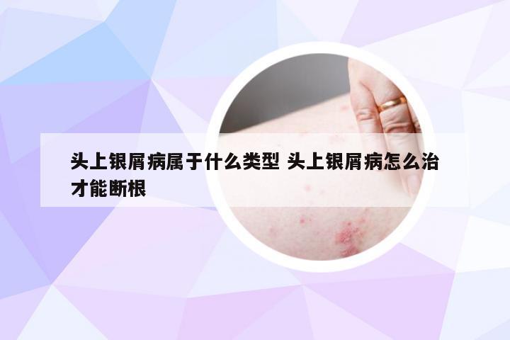 头上银屑病属于什么类型 头上银屑病怎么治才能断根