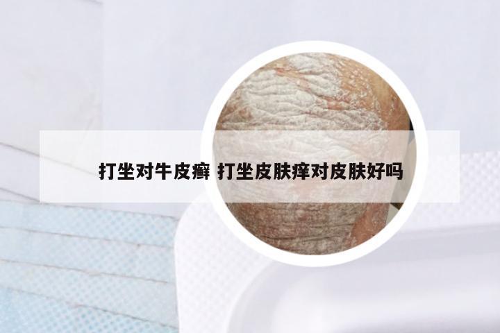 打坐对牛皮癣 打坐皮肤痒对皮肤好吗