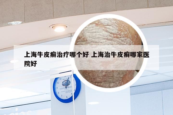 上海牛皮癣治疗哪个好 上海治牛皮癣哪家医院好