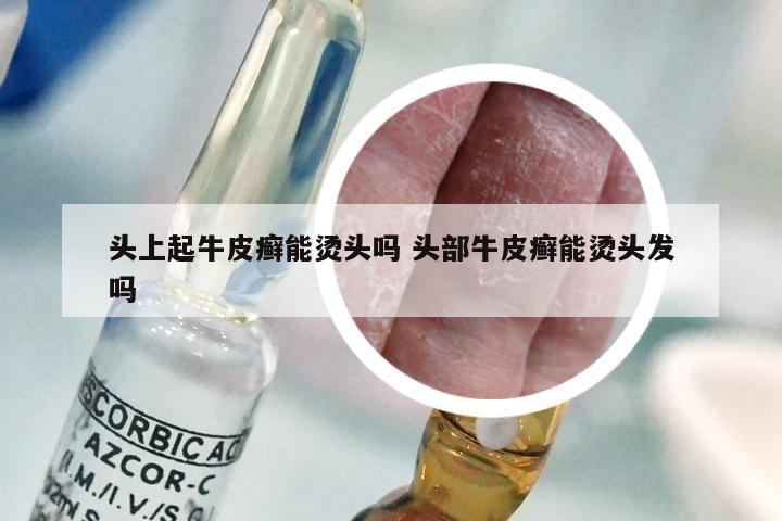 头上起牛皮癣能烫头吗 头部牛皮癣能烫头发吗