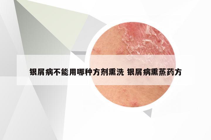 银屑病不能用哪种方剂熏洗 银屑病熏蒸药方