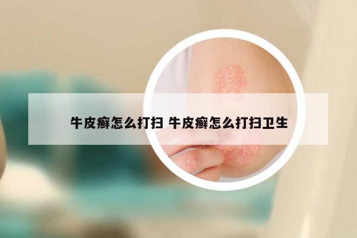 牛皮癣怎么打扫 牛皮癣怎么打扫卫生