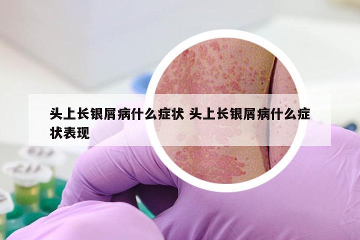 头上长银屑病什么症状 头上长银屑病什么症状表现