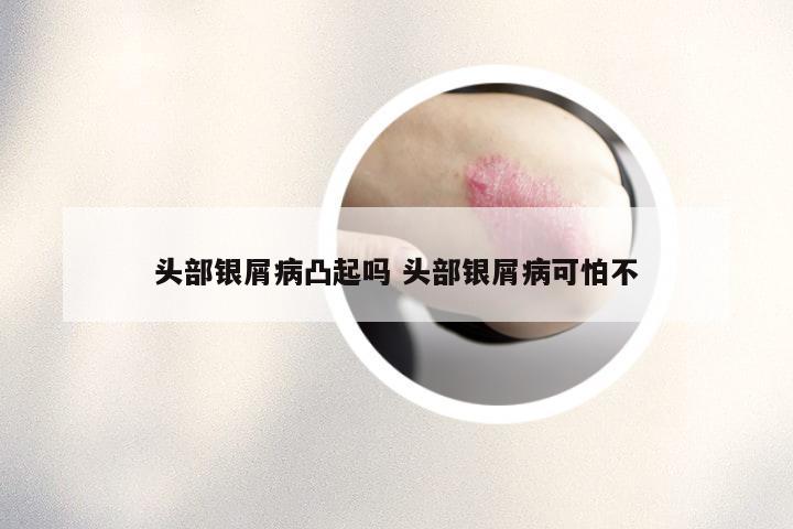 头部银屑病凸起吗 头部银屑病可怕不