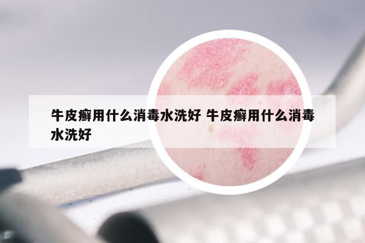 牛皮癣用什么消毒水洗好 牛皮癣用什么消毒水洗好