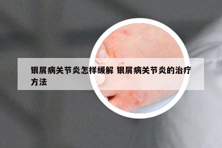 银屑病关节炎怎样缓解 银屑病关节炎的治疗方法