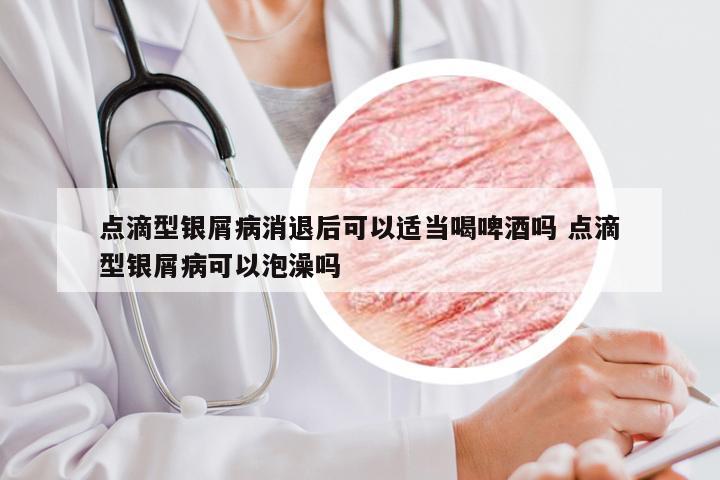 点滴型银屑病消退后可以适当喝啤酒吗 点滴型银屑病可以泡澡吗