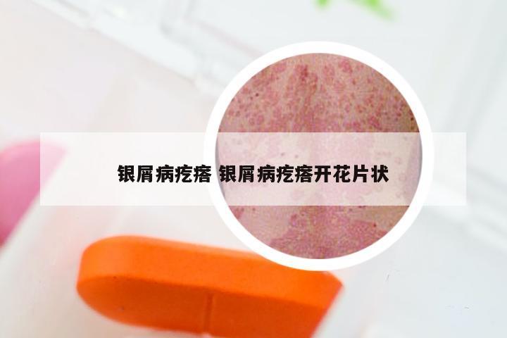 银屑病疙瘩 银屑病疙瘩开花片状