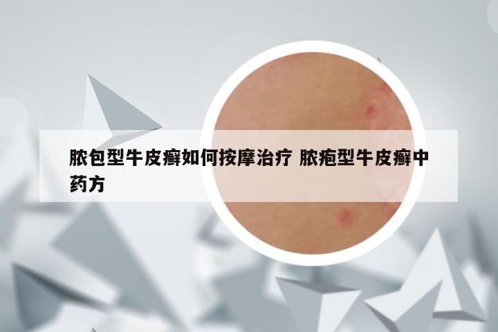 脓包型牛皮癣如何按摩治疗 脓疱型牛皮癣中药方