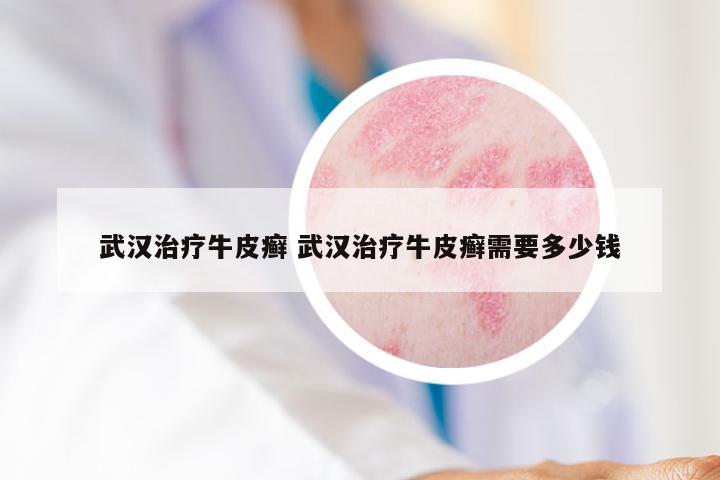 武汉治疗牛皮癣 武汉治疗牛皮癣需要多少钱