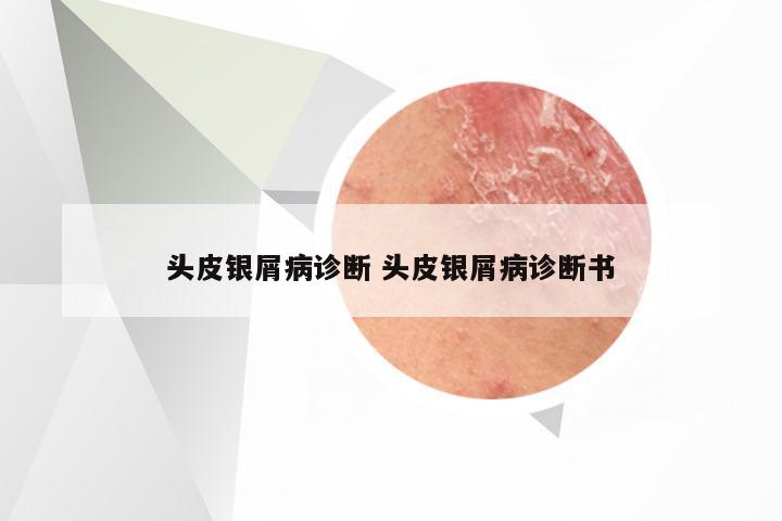 头皮银屑病诊断 头皮银屑病诊断书