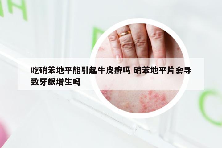 吃硝苯地平能引起牛皮癣吗 硝苯地平片会导致牙龈增生吗