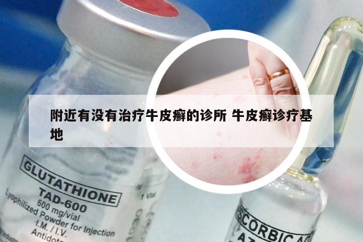 附近有没有治疗牛皮癣的诊所 牛皮癣诊疗基地