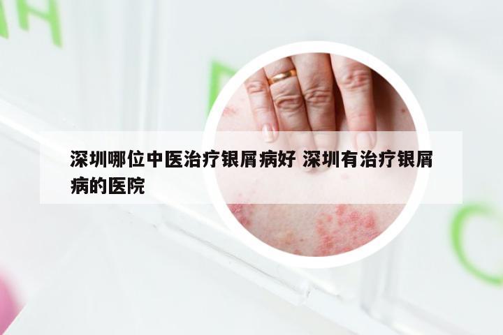 深圳哪位中医治疗银屑病好 深圳有治疗银屑病的医院