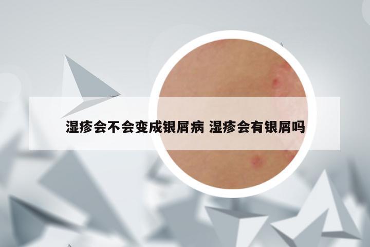 湿疹会不会变成银屑病 湿疹会有银屑吗