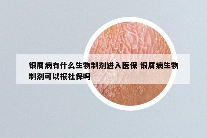 银屑病有什么生物制剂进入医保 银屑病生物制剂可以报社保吗