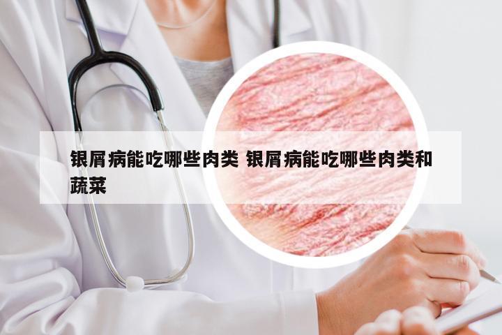 银屑病能吃哪些肉类 银屑病能吃哪些肉类和蔬菜