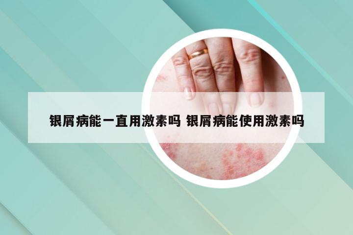 银屑病能一直用激素吗 银屑病能使用激素吗
