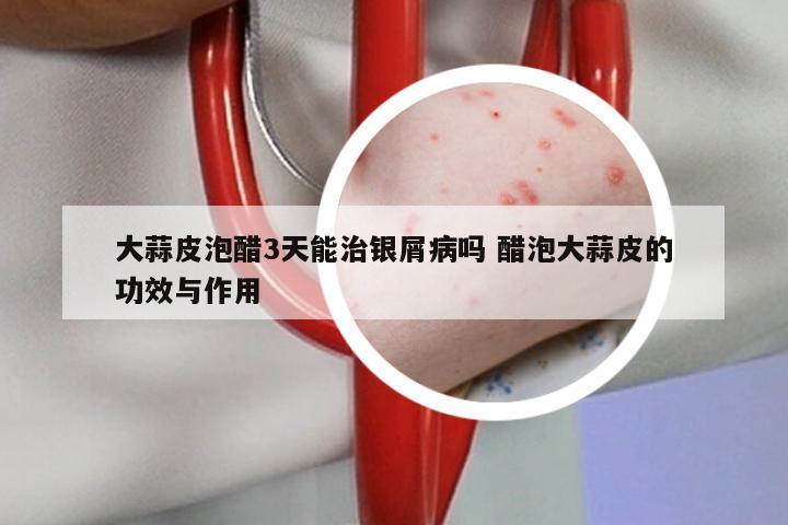 大蒜皮泡醋3天能治银屑病吗 醋泡大蒜皮的功效与作用