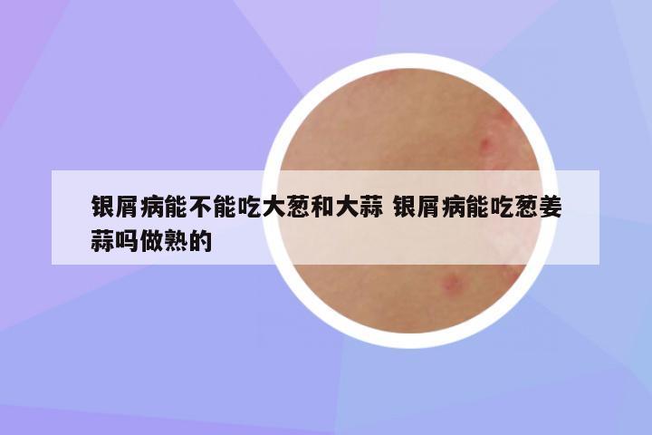 银屑病能不能吃大葱和大蒜 银屑病能吃葱姜蒜吗做熟的