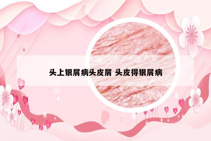 头上银屑病头皮屑 头皮得银屑病