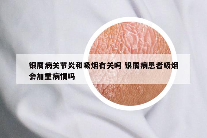 银屑病关节炎和吸烟有关吗 银屑病患者吸烟会加重病情吗