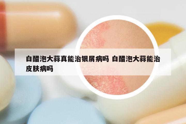 白醋泡大蒜真能治银屑病吗 白醋泡大蒜能治皮肤病吗