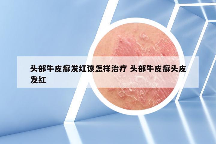头部牛皮癣发红该怎样治疗 头部牛皮癣头皮发红