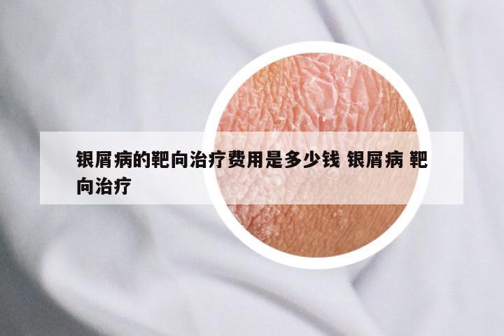 银屑病的靶向治疗费用是多少钱 银屑病 靶向治疗