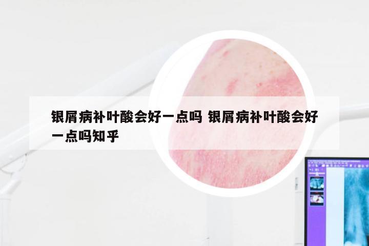 银屑病补叶酸会好一点吗 银屑病补叶酸会好一点吗知乎