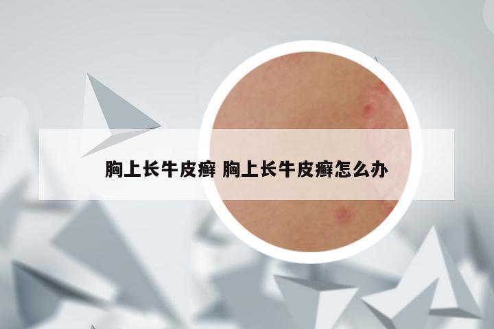 胸上长牛皮癣 胸上长牛皮癣怎么办