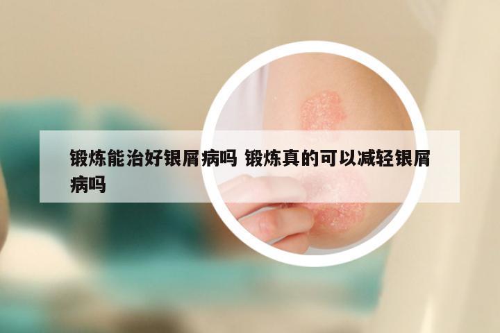 锻炼能治好银屑病吗 锻炼真的可以减轻银屑病吗