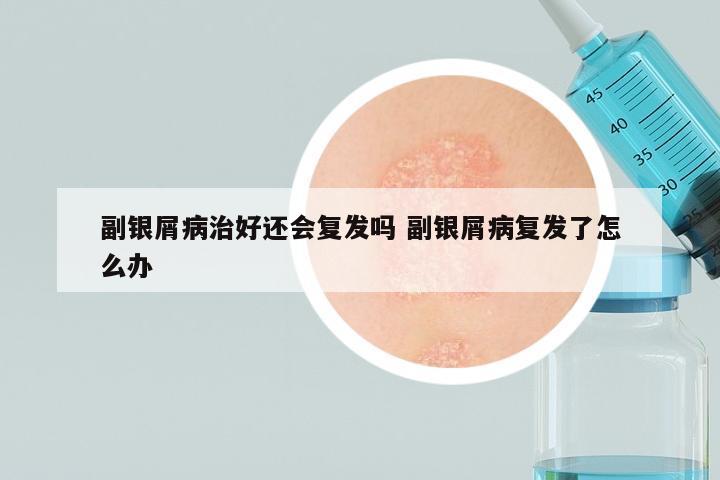 副银屑病治好还会复发吗 副银屑病复发了怎么办