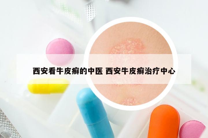 西安看牛皮癣的中医 西安牛皮癣治疗中心