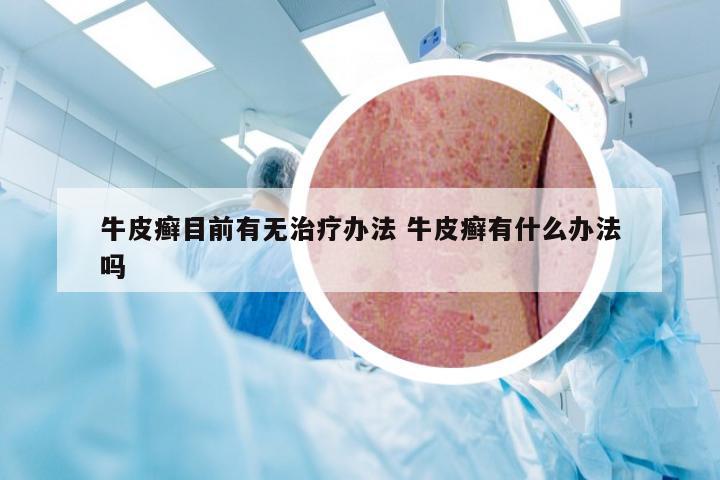 牛皮癣目前有无治疗办法 牛皮癣有什么办法吗