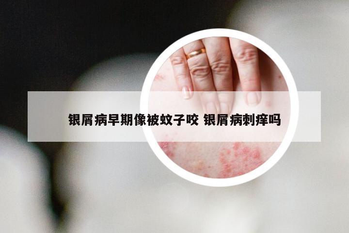 银屑病早期像被蚊子咬 银屑病刺痒吗