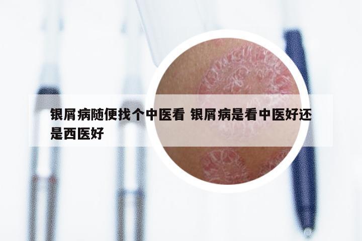 银屑病随便找个中医看 银屑病是看中医好还是西医好
