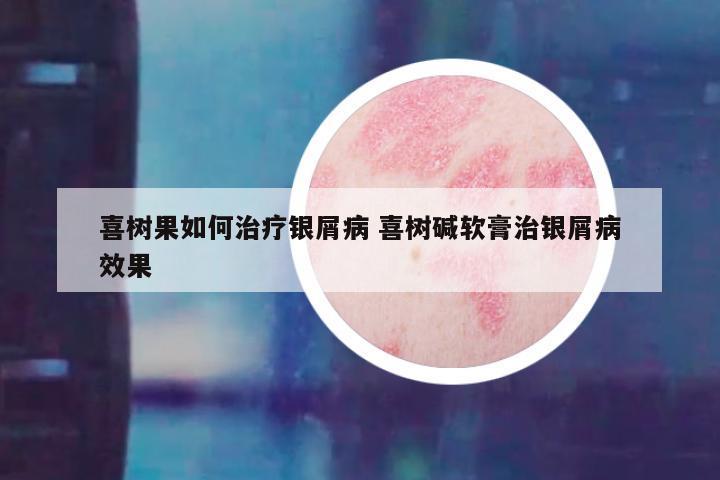 喜树果如何治疗银屑病 喜树碱软膏治银屑病效果