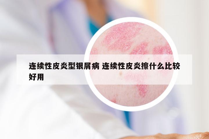 连续性皮炎型银屑病 连续性皮炎擦什么比较好用