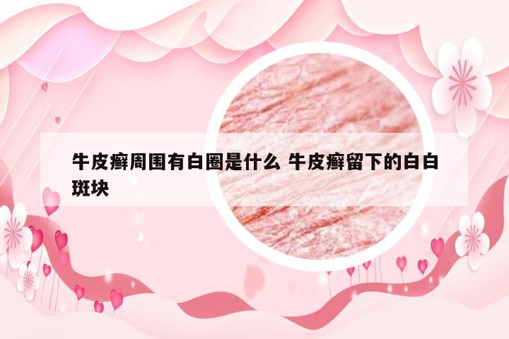牛皮癣周围有白圈是什么 牛皮癣留下的白白斑块