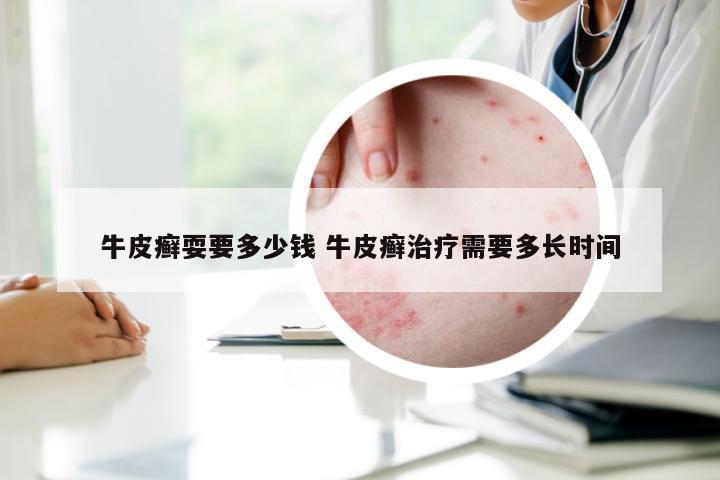 牛皮癣耍要多少钱 牛皮癣治疗需要多长时间