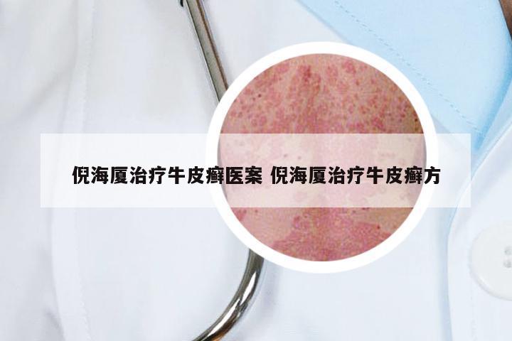 倪海厦治疗牛皮癣医案 倪海厦治疗牛皮癣方