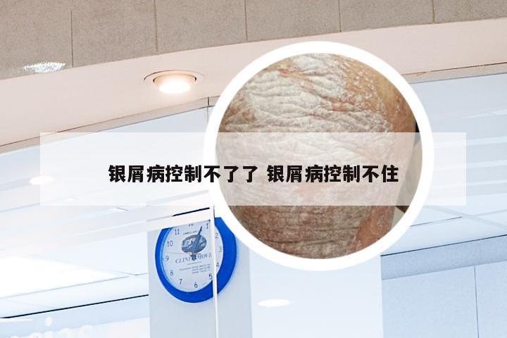 银屑病控制不了了 银屑病控制不住