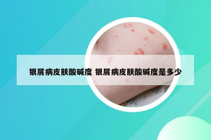银屑病皮肤酸碱度 银屑病皮肤酸碱度是多少