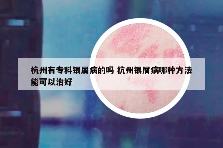 杭州有专科银屑病的吗 杭州银屑病哪种方法能可以治好