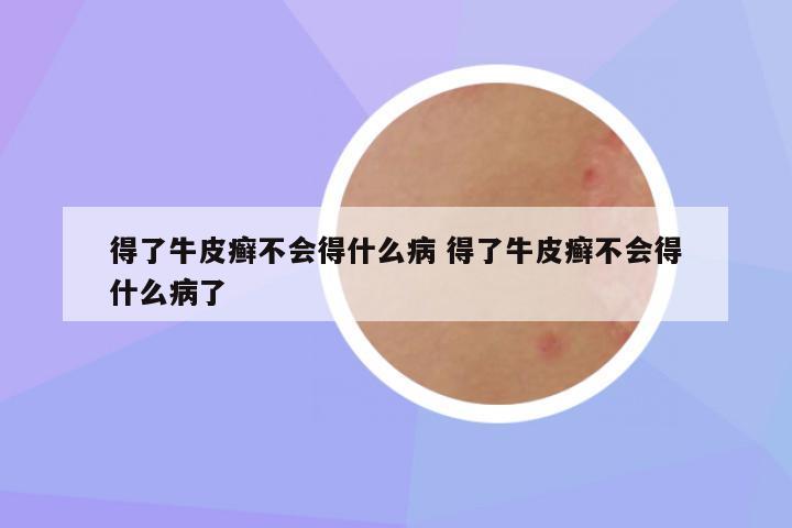 得了牛皮癣不会得什么病 得了牛皮癣不会得什么病了