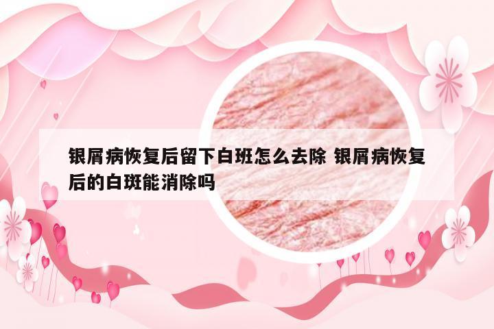 银屑病恢复后留下白班怎么去除 银屑病恢复后的白斑能消除吗