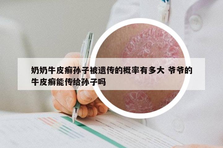 奶奶牛皮癣孙子被遗传的概率有多大 爷爷的牛皮癣能传给孙子吗